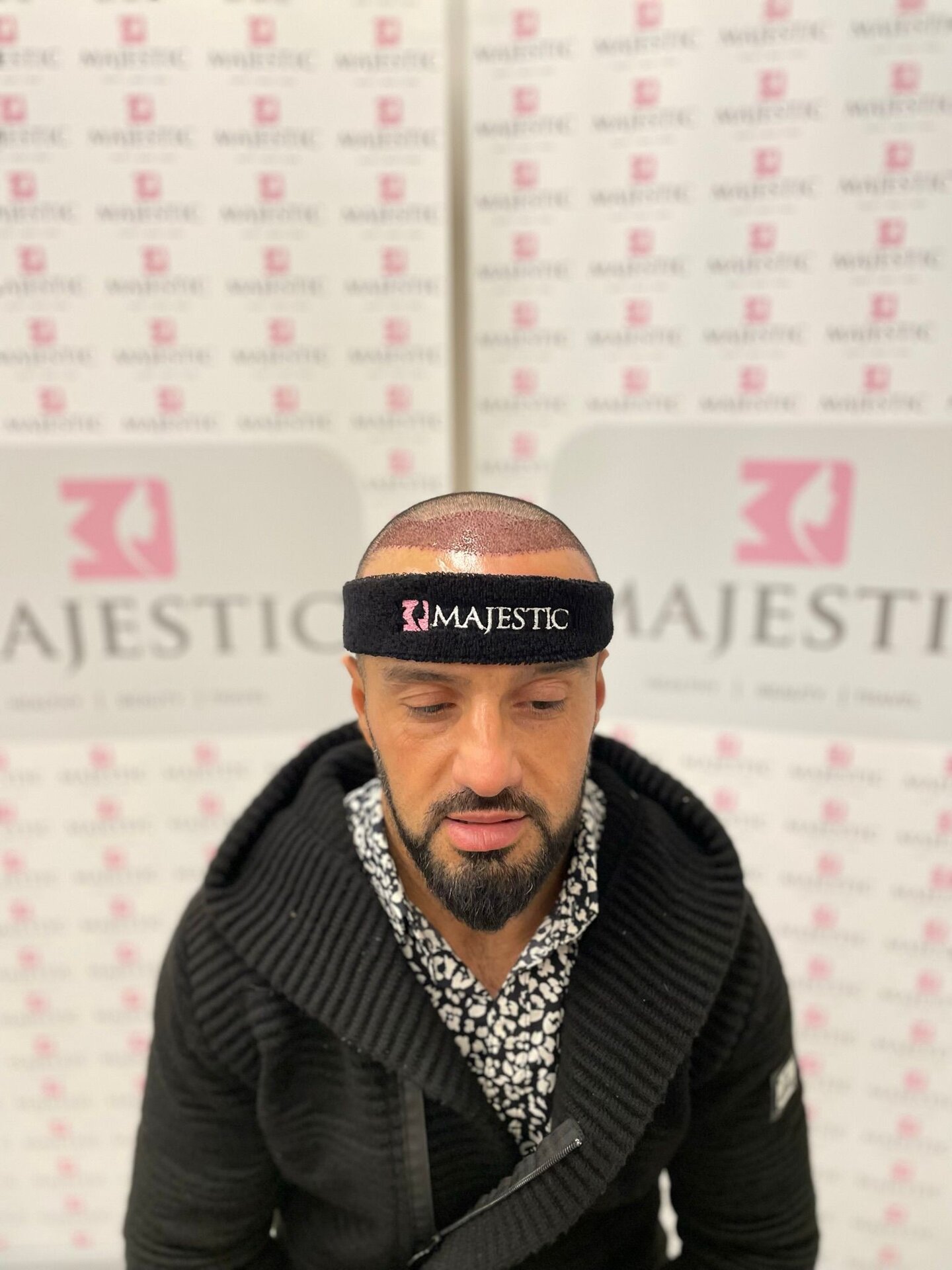 Hair Transplant Result