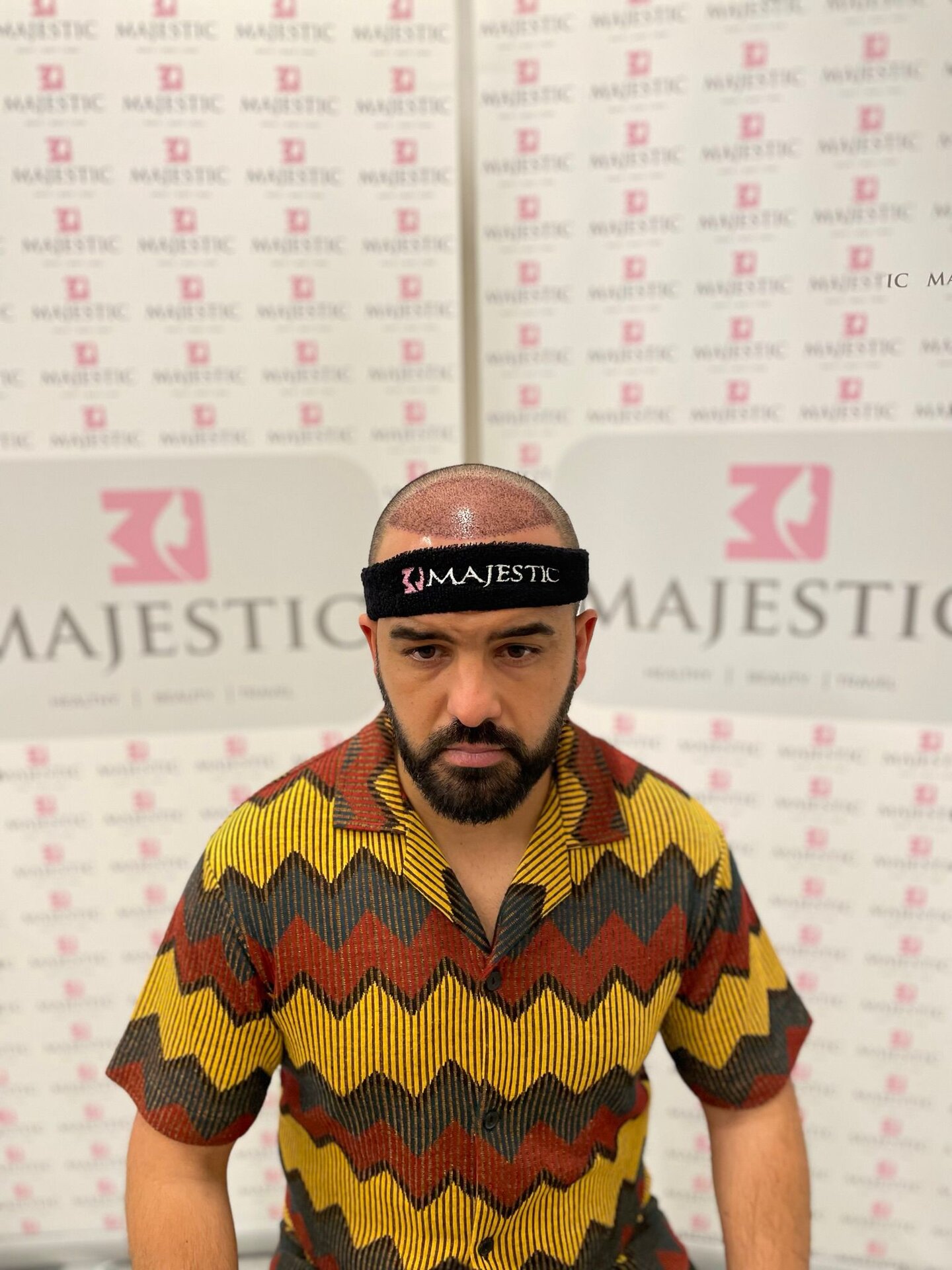 Hair Transplant Result