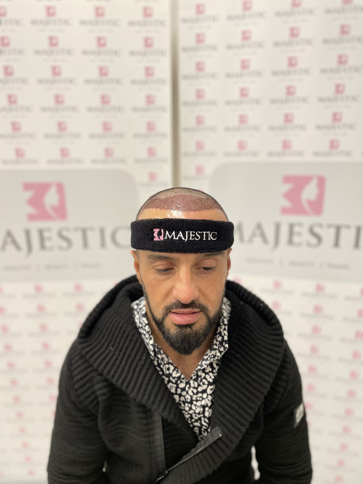 Hair Transplant Result